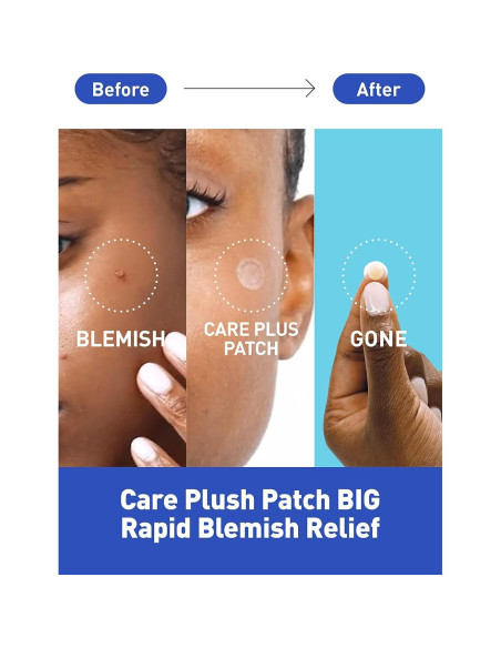 Parche para Acné OLIVE YOUNG Hidrocoloide 102 Unidades