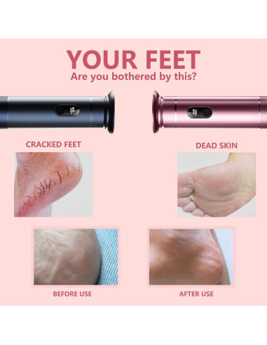 Removedor de Callos Eléctrico SUILU Oro Rosa con Discos de Lija