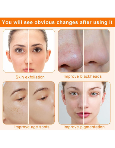 Máquina de Microdermoabrasión Mcwdoit 3 en 1 Facial Exfoliación