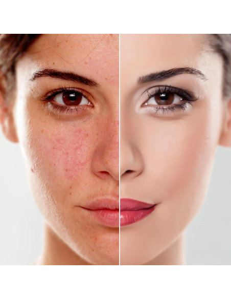 Máquina de Microdermoabrasión 3 en 1 mcwdoit 30,4x23,6cm