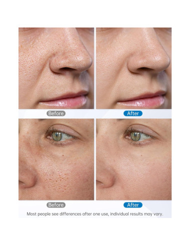 Máquina de Microdermoabrasión Facial UNOISETION 2 en 1