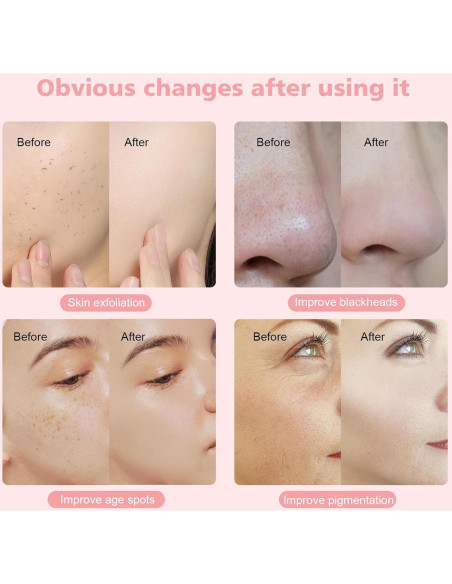 Máquina de Microdermoabrasión Mcwdoit 3 en 1 Cuidado Facial