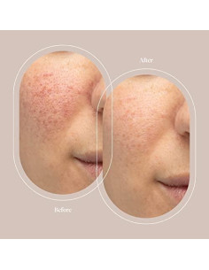 Filtros de Reemplazo Trophy Skin para Microdermoabrasión - Paquete de 100 2