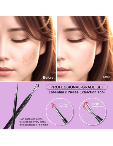 Herramienta Extractora de Espinillas Teenitor 2-en-1 Acero Inoxidable