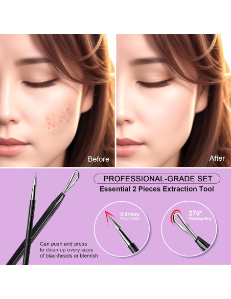 Herramienta Extractora de Espinillas Teenitor 2-en-1 Acero Inoxidable