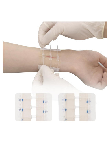 Dispositivo de Cierre de Heridas MaiWieel Sin Suturas 2 Piezas