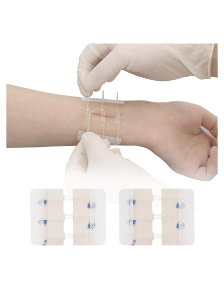 Dispositivo de Cierre de Heridas MaiWieel Sin Suturas 2 Piezas