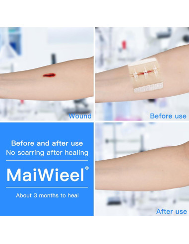 Dispositivo de Cierre de Heridas MaiWieel Sin Suturas 2 Piezas