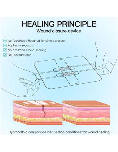 Dispositivo de Cierre de Heridas MaiWieel Sin Suturas 2 Piezas