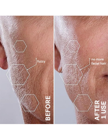 Sistema de Dermaplanado Michael Todd Beauty Sonicsmooth 340g