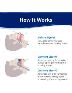 Dispositivo Bucal Antisnore ZQuiet + Limpiador 44.36ml 2