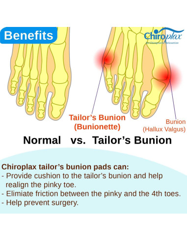 Corrector de Juanete Chiroplax Pequeño - Almohadillas 6 Unidades