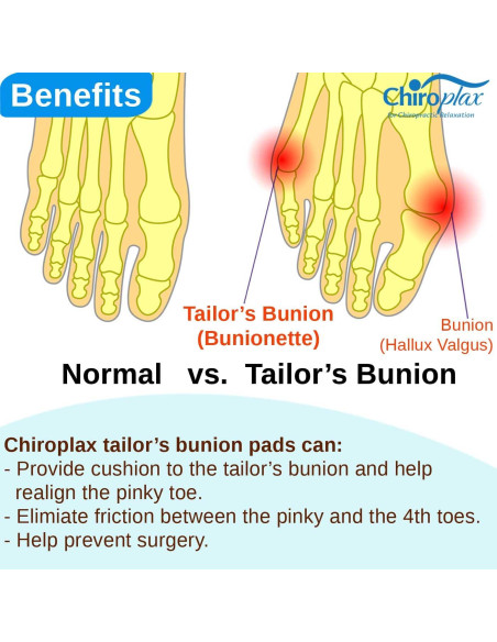 Corrector de Juanete Chiroplax Pequeño - Almohadillas 6 Unidades