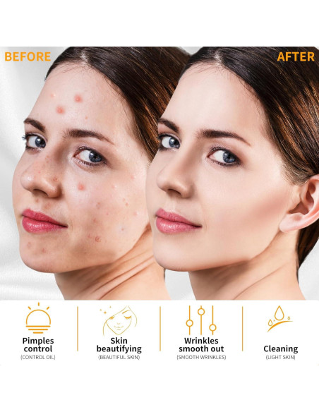 Máquina de Cuidado Facial Portátil MYSWEETY Alta Frecuencia