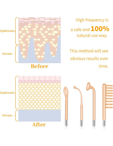 Máquina de Cuidado Facial Portátil MYSWEETY Alta Frecuencia