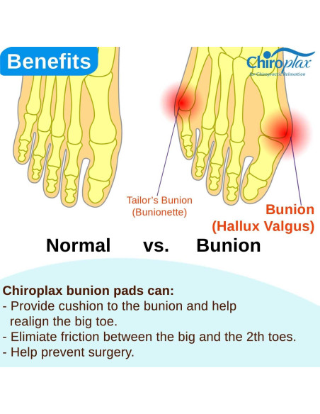 Corrector de Juanetes Chiroplax - Almohadillas de Gel Grande