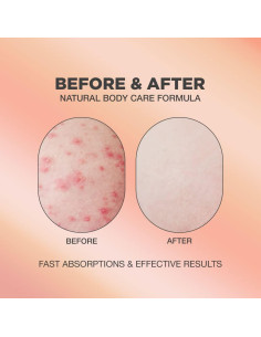 Suero Corporal AHA BHA Proot para Acné y Vello Encarnado 48g 2