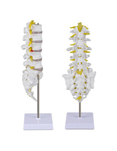 Modelo de Columna Lumbar Ultrassist con Discos Herniados 31.85cm