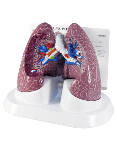 Modelo de Pulmón con Patologías GPI Anatomicals 28.6x28.6cm