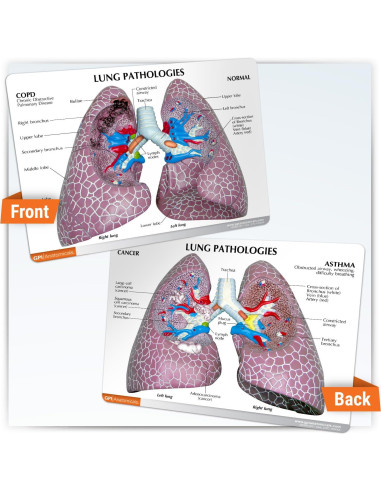 Modelo de Pulmón con Patologías GPI Anatomicals 28.6x28.6cm