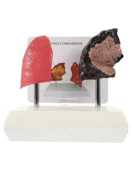 Modelo de Pulmón Hemoton 1:1 Saludable y Fumador PVC