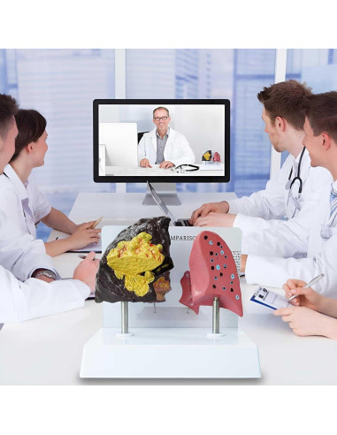 Modelo Anatómico de Pulmón Fumador vs Saludable PVC 21.96x13.99cm