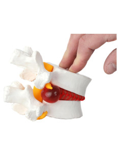 Modelo de Anatomía de Disco Herniado Lumbar Axis Scientific