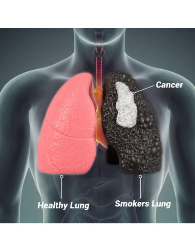 Modelo de Pulmón Saludable vs Fumador Ultrassist Mini 10.9cm