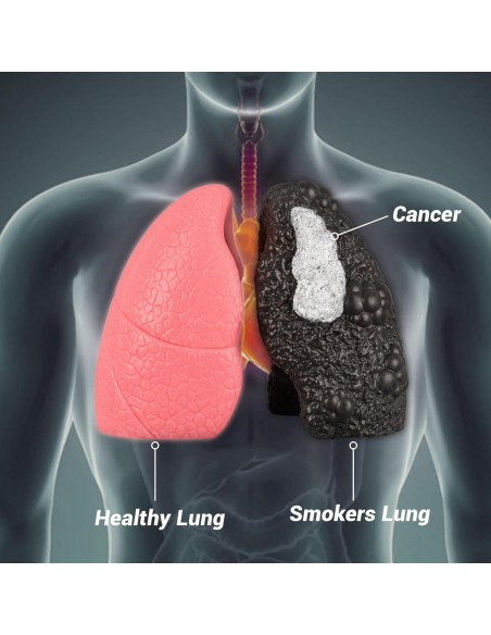 Modelo de Pulmón Saludable vs Fumador Ultrassist Mini 10.9cm