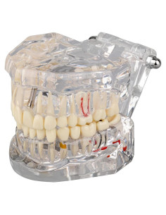 Modelo Dental Patológico Transparente Ultrassist 6.5x8.9cm