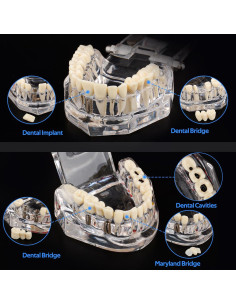 Modelo Dental Patológico Transparente Ultrassist 6.5x8.9cm 2