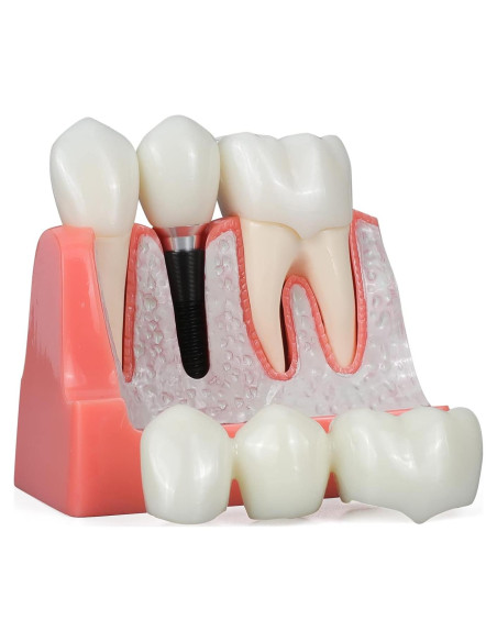 Modelo de Implante Dental ANNWAN 4 Veces Removible para Educación