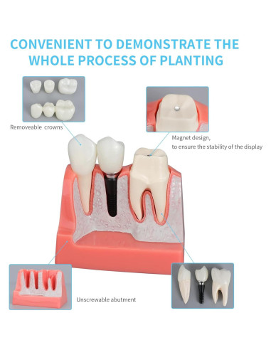 Modelo de Implante Dental ANNWAN 4 Veces Removible para Educación