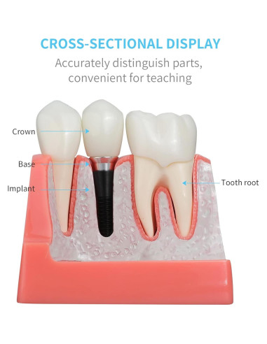 Modelo de Implante Dental ANNWAN 4 Veces Removible para Educación