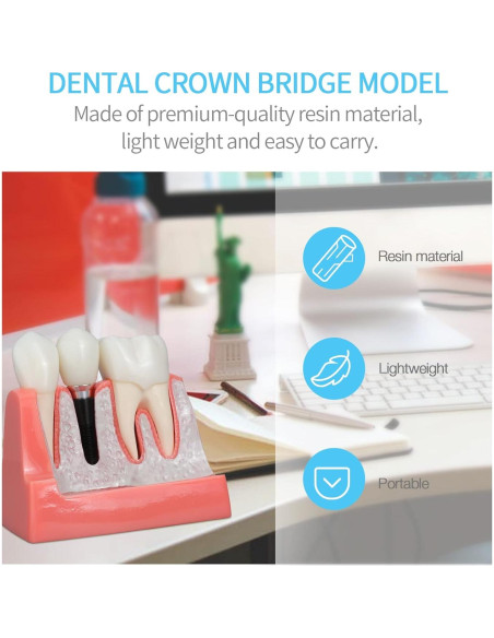 Modelo de Implante Dental ANNWAN 4 Veces Removible para Educación