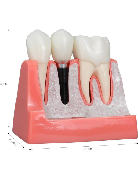 Modelo de Implante Dental ANNWAN 4 Veces Removible para Educación