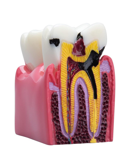 Modelo de Caries Dental LVCHEN 8.7x7.6 cm Resina Educativa Modelo de Caries Dental LVCHEN 8.7x7.6 cm Resina Educativa