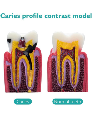 Modelo de Caries Dental LVCHEN 8.7x7.6 cm Resina Educativa