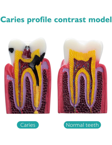 Modelo de Caries Dental LVCHEN 8.7x7.6 cm Resina Educativa Modelo de Caries Dental LVCHEN 8.7x7.6 cm Resina Educativa