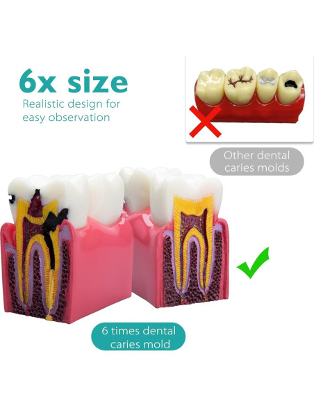 Modelo de Caries Dental LVCHEN 8.7x7.6 cm Resina Educativa Modelo de Caries Dental LVCHEN 8.7x7.6 cm Resina Educativa