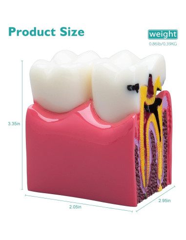 Modelo de Caries Dental LVCHEN 8.7x7.6 cm Resina Educativa