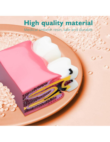 Modelo de Caries Dental LVCHEN 8.7x7.6 cm Resina Educativa