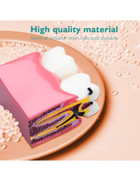 Modelo de Caries Dental LVCHEN 8.7x7.6 cm Resina Educativa Modelo de Caries Dental LVCHEN 8.7x7.6 cm Resina Educativa