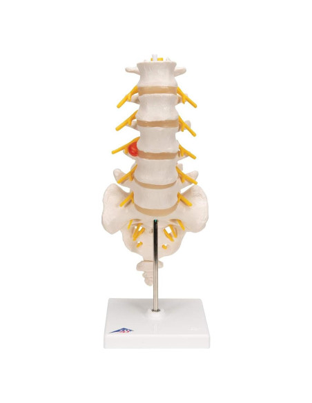 Columna Vertebral Lumbar 3B Scientific A76/5 con Disco Prolapsado 34 cm