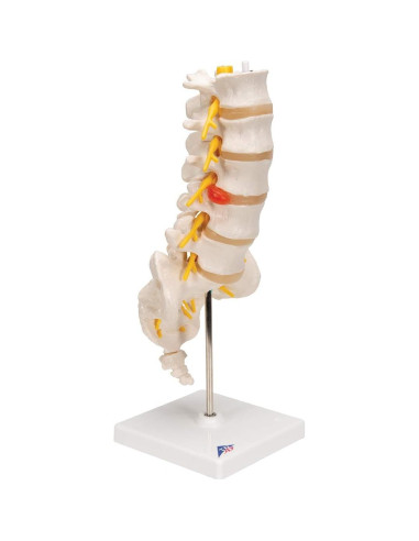 Columna Vertebral Lumbar 3B Scientific A76/5 con Disco Prolapsado 34 cm