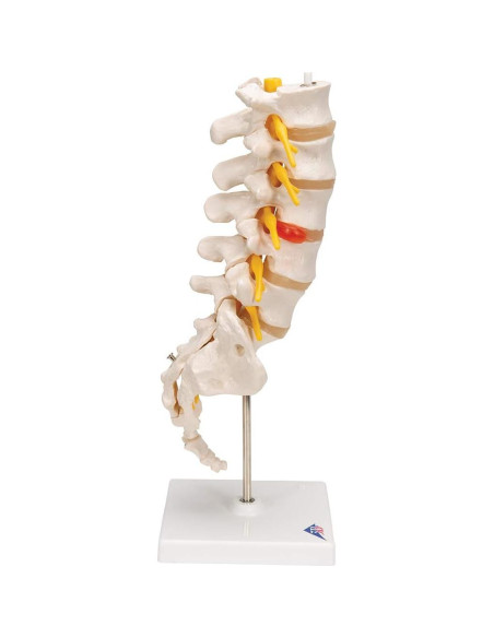 Columna Vertebral Lumbar 3B Scientific A76/5 con Disco Prolapsado 34 cm