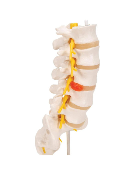 Columna Vertebral Lumbar 3B Scientific A76/5 con Disco Prolapsado 34 cm