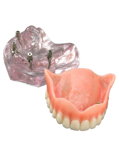 Modelo Dental Sobredentadura Superior Smile1000 4 Implantes