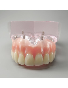 Modelo Dental Sobredentadura Superior Smile1000 4 Implantes 2