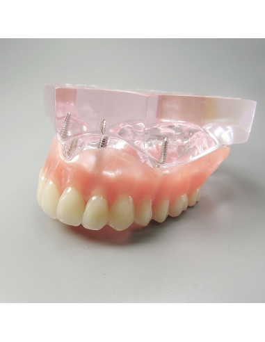 Modelo Dental Sobredentadura Superior Smile1000 4 Implantes